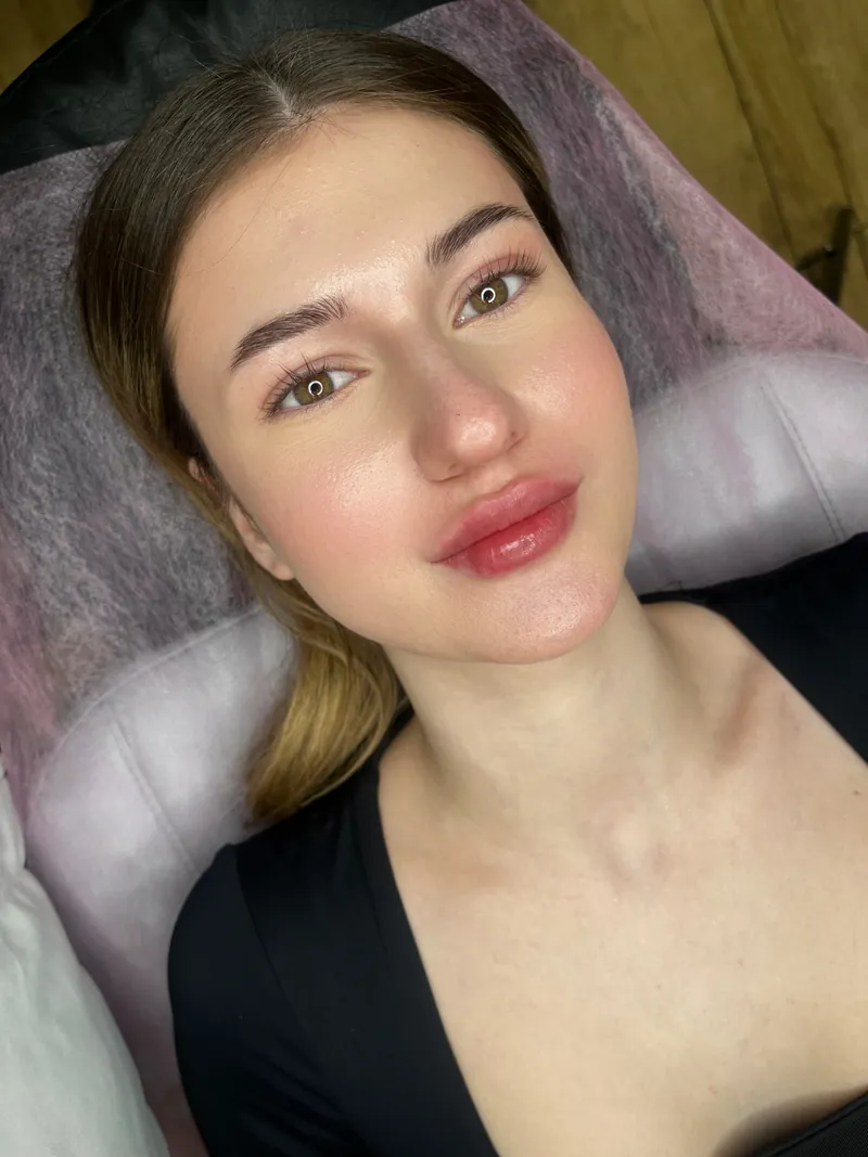 Subtle lip enhancement — full face shot