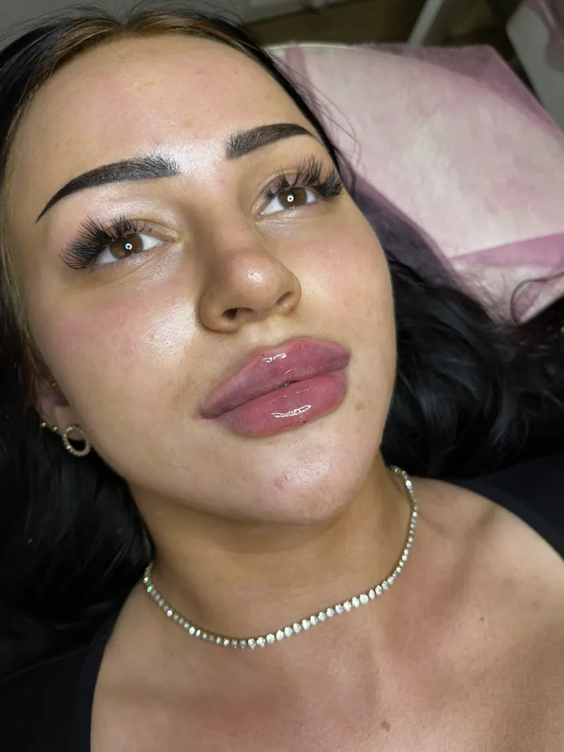 Lip augmentation effect in facial proportions — 3/4 view