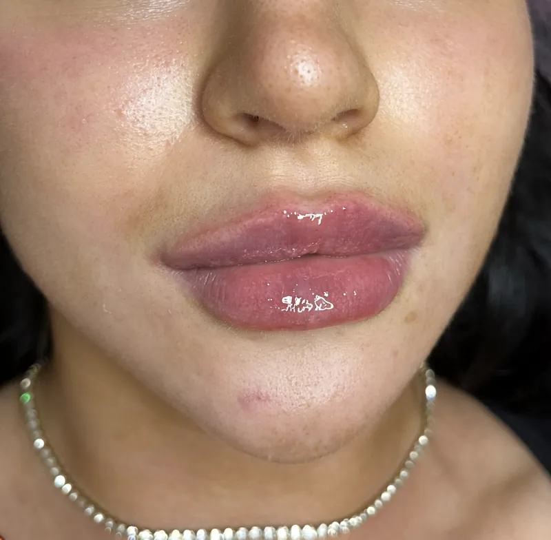 Lip detail after treatment — frame from nose to chin