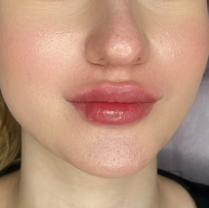 Lip shape and volume — frame from nose to chin